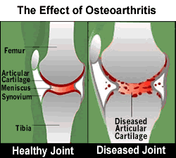 Healthy Joint & Diseased Joint